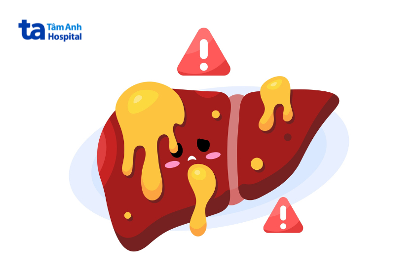 gan bị nhiễm mỡ