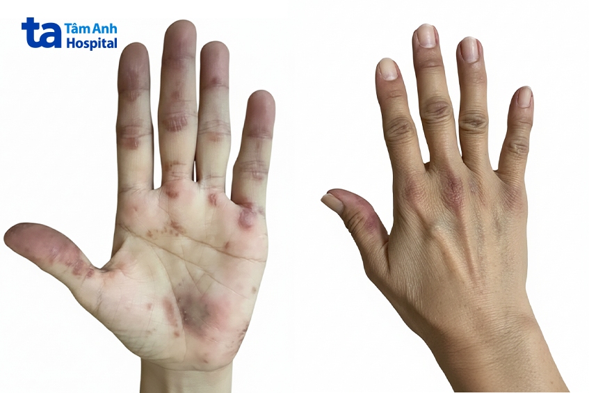 hai bàn tay chị mỹ bong tróc, nổi hồng ban, dày sừng trong hơn 2 năm
