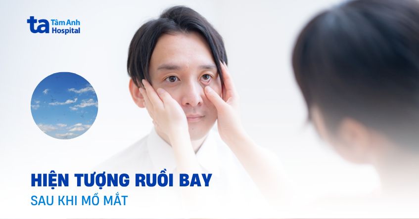Dính hiện tượng ruồi bay sau khi mổ mắt kéo dài tới bao giờ?