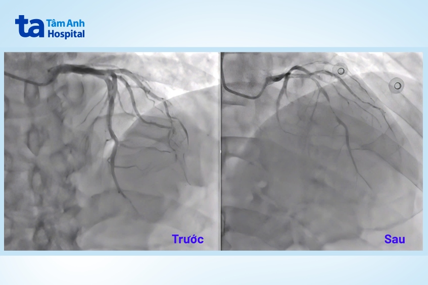 Hình ảnh động mạch vành co thắt gây hẹp khít đường kính mạch máu sau khi được tiêm thuốc ergonovine