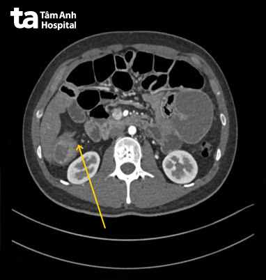 hình ảnh khối u lớn