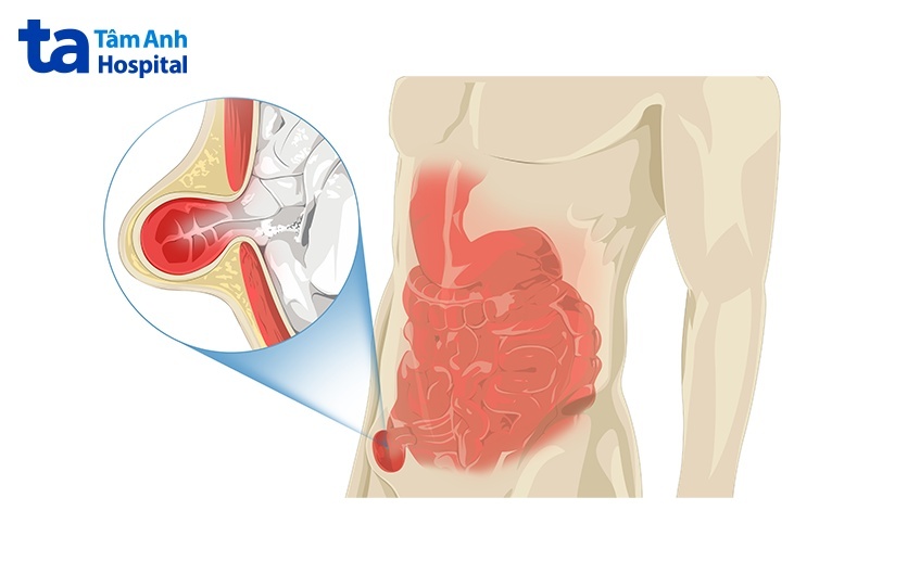 hình ảnh minh họa thoát vị bẹn