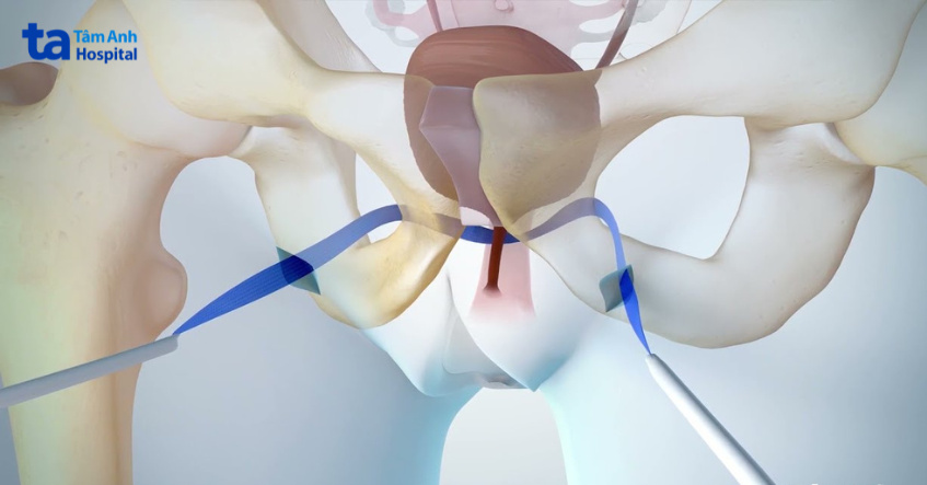 hình ảnh minh họa thủ thuật tot