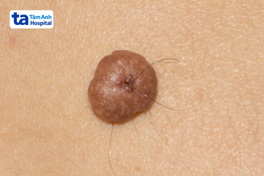 hình ảnh nốt ruồi ở nhũ hoa