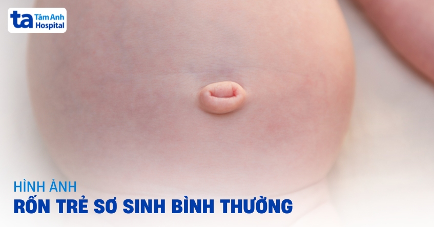 Hình ảnh rốn trẻ sơ sinh bình thường và bất thường hay gặp nhất