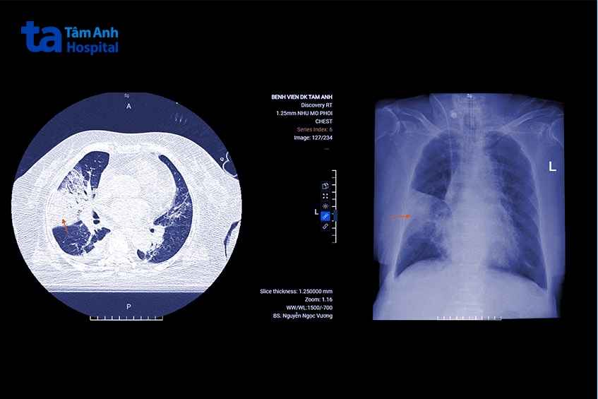 hình ảnh tổn thương đông đặc ở phổi