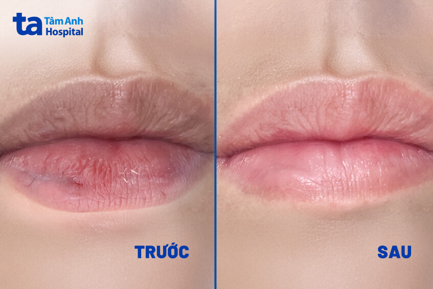 hình ảnh trước và sau khi điều trị