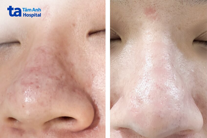 hình ảnh vùng mũi trước và sau điều trị