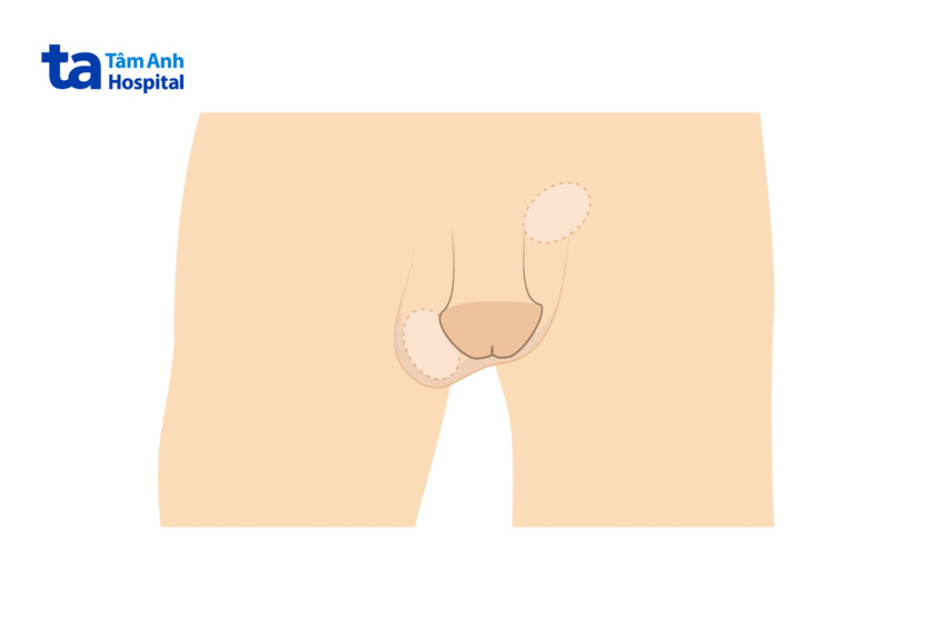 hình minh họa tinh hoàn bị co rút