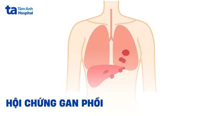 Hội chứng gan phổi: Cách phát hiện​ thế nào?
