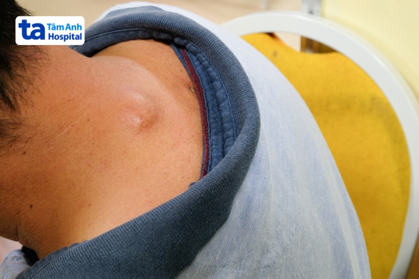 kén bã đậu phía sau cổ gây mất thẩm mỹ