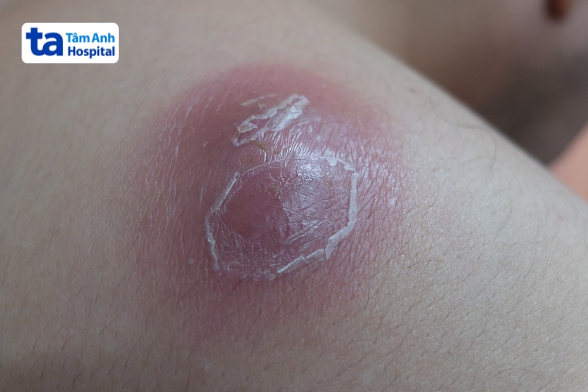 kén bã đậu sưng to, tấy đỏ do viêm