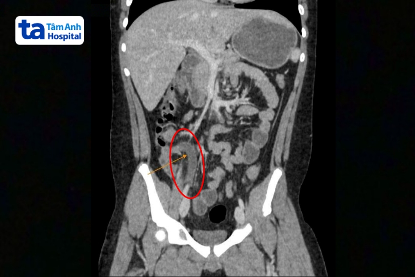 kết quả chụp ct phát hiện có ruột thừa bị viêm kèm sỏi phân.