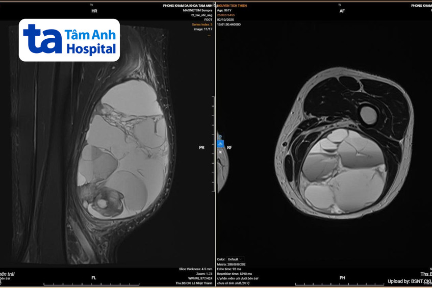 Kết quả MRI phát hiện tổn thương choán chỗ lớn vùng sau đùi trái