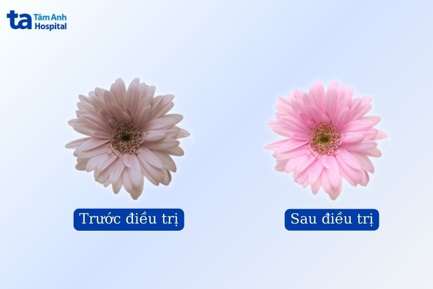 kết quả trước và sau điều trị