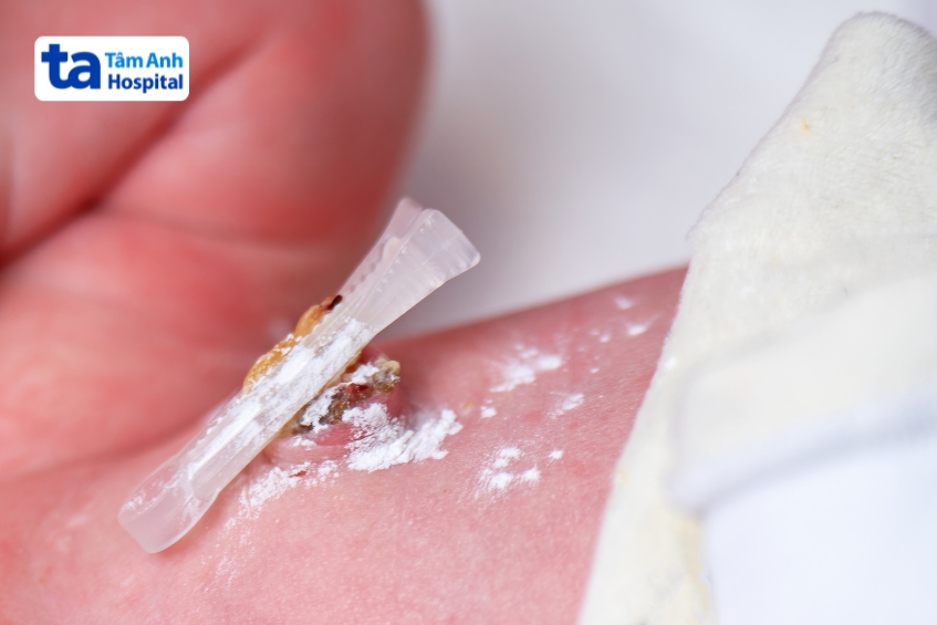 không tự ý đắp thuốc hoặc áp dụng các mẹo dân gian lên vùng rốn của trẻ