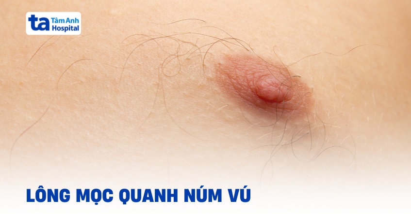 Lông mọc quanh nhũ hoa: Sinh lý hay bệnh lý?