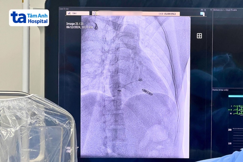 Máy tạo nhịp không dây được đưa vào cơ thể người bệnh