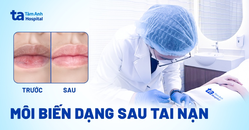 Môi biến dạng sau tai nạn giao thông