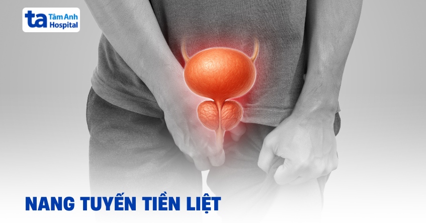 Nang tuyến tiền liệt: Nguyên nhân, dấu hiệu và cách điều trị