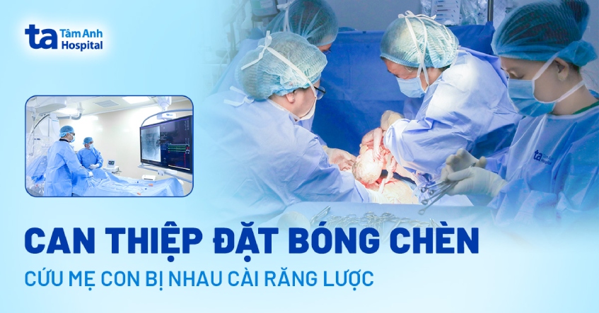 Nhau cài răng lược xuyên thủng tử cung sản phụ