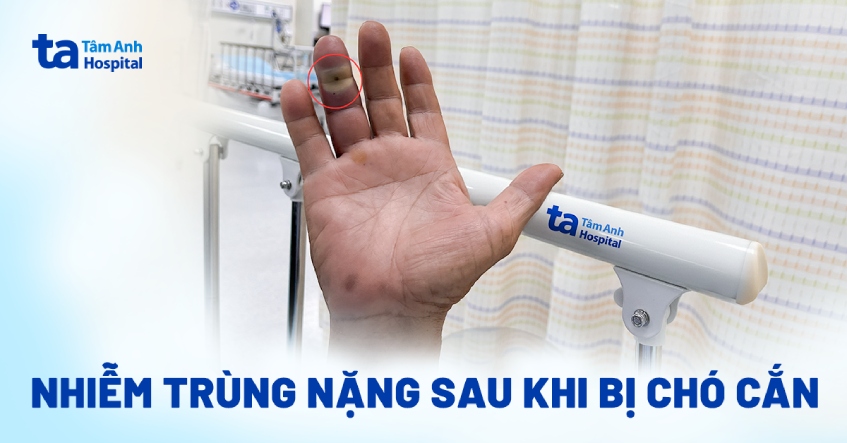 Nhiễm trùng nặng sau khi bị chó cắn