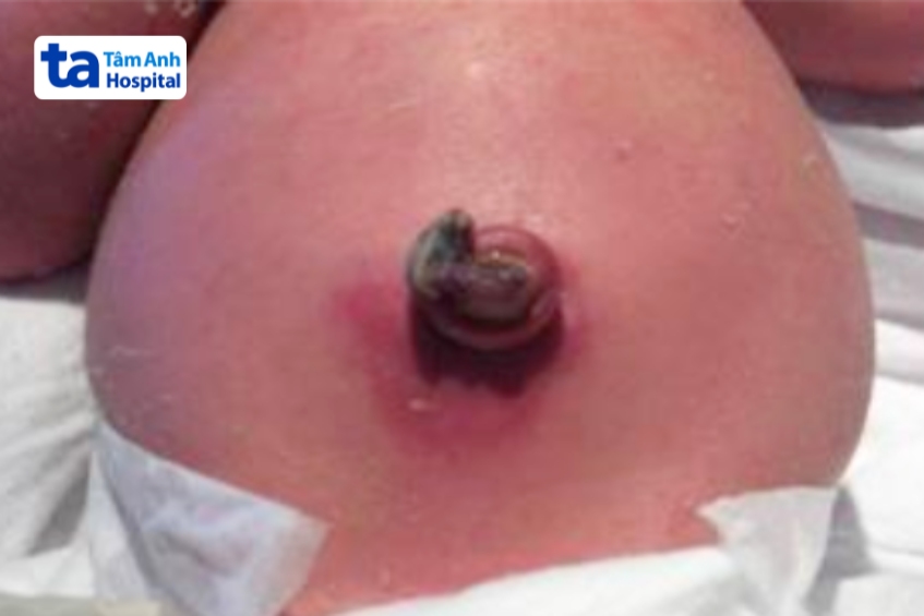 nhiễm trùng rốn