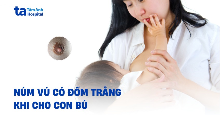 Nhũ hoa có đốm trắng có phải biểu hiện bất thường?
