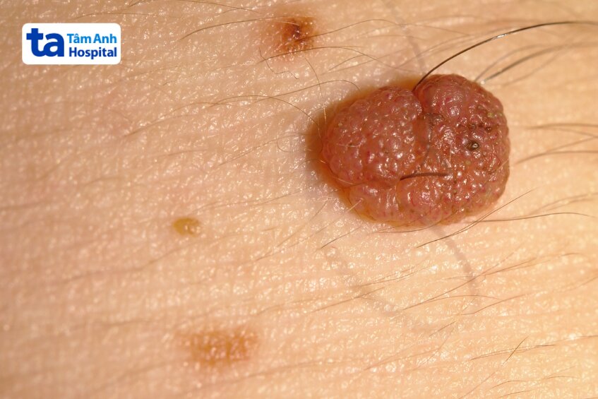 nốt ruồi ở nhũ hoa mắc phải