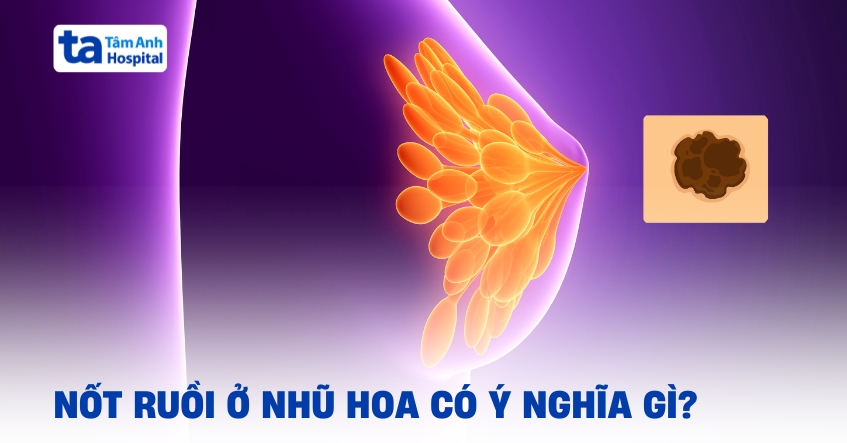 Nốt ruồi ở nhũ hoa: Ý nghĩa và cảnh báo nguy cơ