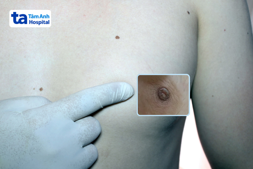 núm vú bị chẻ đôi có sao không