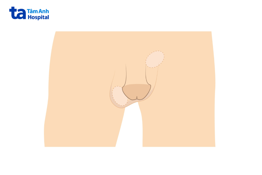 Ở người mắc hội chứng kháng androgen, một hoặc cả hai tinh hoàn chưa hạ xuống bìu