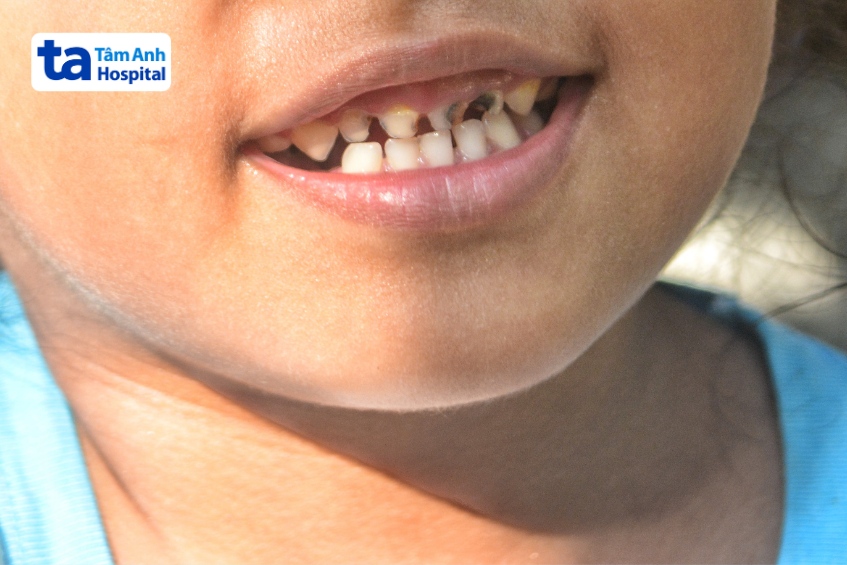 phần lớn trẻ có thể bị sâu răng nếu vệ sinh răng miệng chưa đúng cách