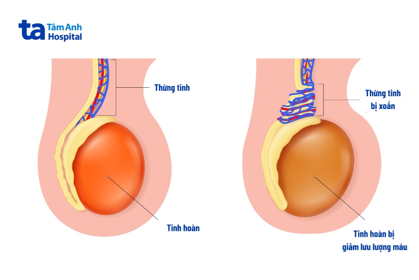 Phẫu thuật cấp cứu tháo xoắn đạt hiệu quả tốt nhất cho tinh hoàn trong 6 giờ đầu