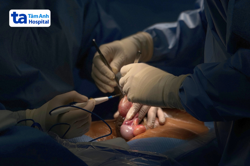 phẫu thuật loại bỏ tinh hoàn 1 bên