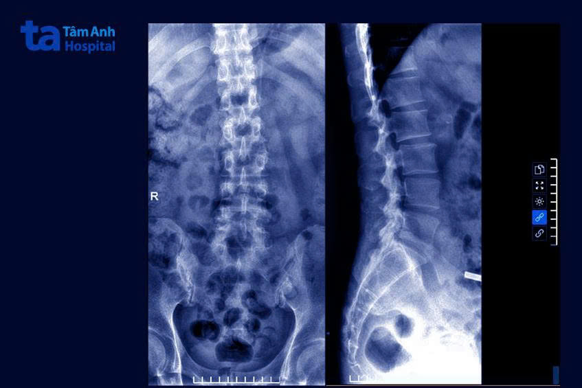 phim chụp x-quang của anh Quang cho thấy biểu hiện viêm khớp cột sống