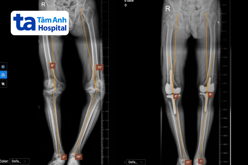 phim chụp x-quang hai chân ông Tri trước (trái) và sau khi thay khớp
