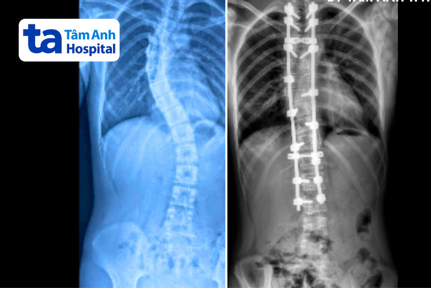 phim chụp X-quang tình trạng cột sống bệnh nhi trước (trái) và sau phẫu thuật