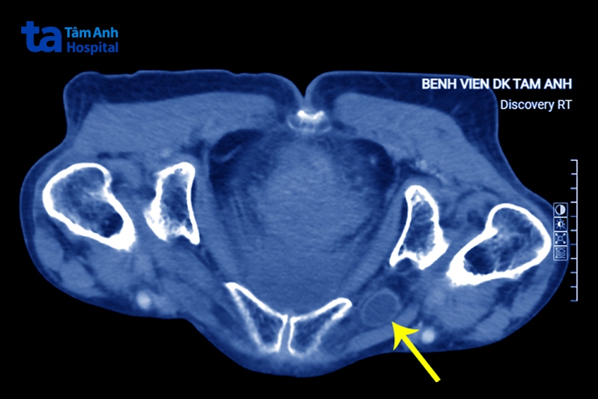 quai ruột non thoát vị