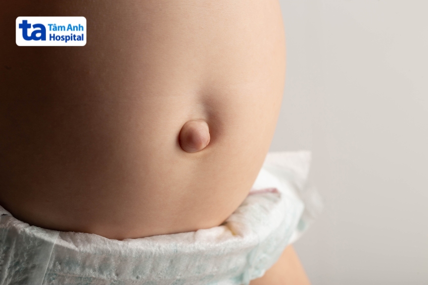 rốn lồi ở trẻ sơ sinh