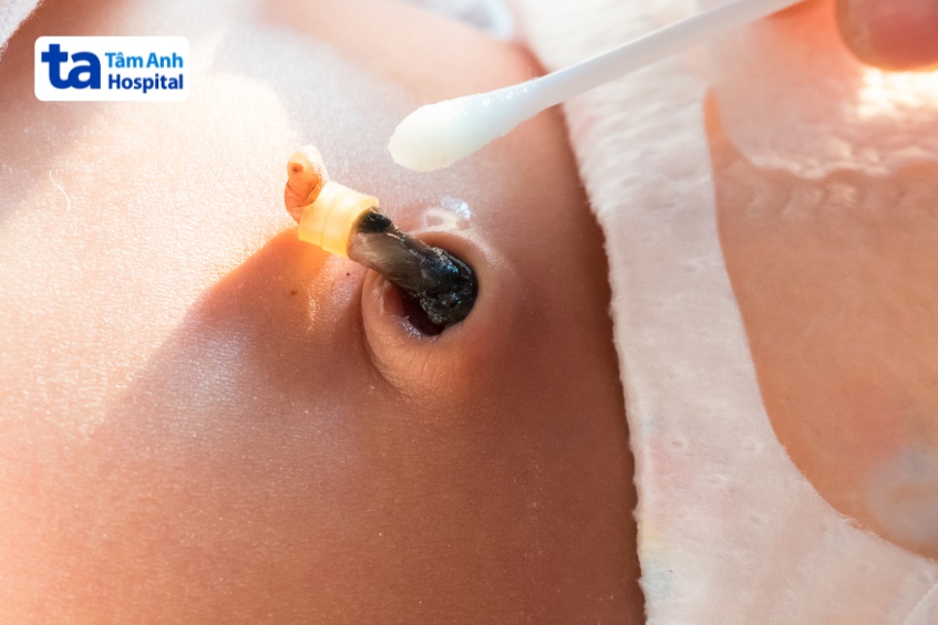 rốn trẻ sơ sinh bị ướt trước khi rụng cuống rốn thường là do sinh lý