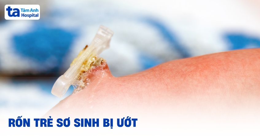 Rốn trẻ sơ sinh bị ướt phải làm sao nhanh khô trước và sau rụng?