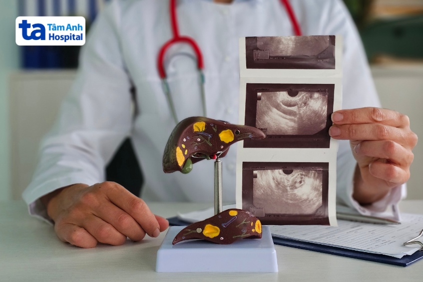 siêu âm chẩn đoán bệnh gan
