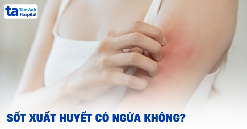 Sốt xuất huyết có ngứa không? Đâu là giải pháp khắc phục?