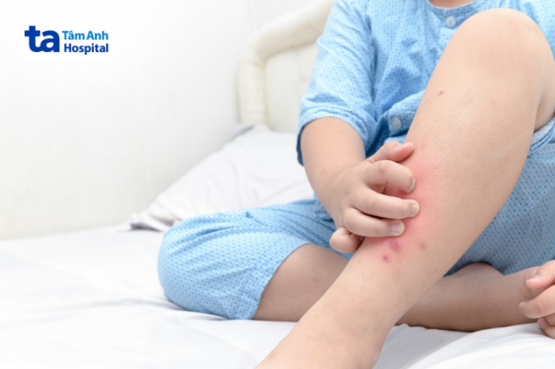 sốt xuất huyết gây ngứa