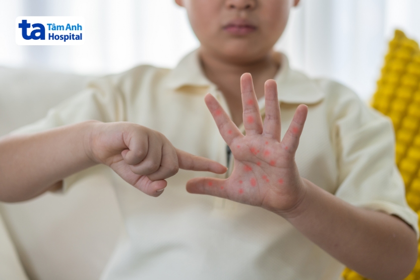 tay chân miệng là bệnh lý dễ lây lan khi trẻ tiếp xúc với bạn bè mắc bệnh