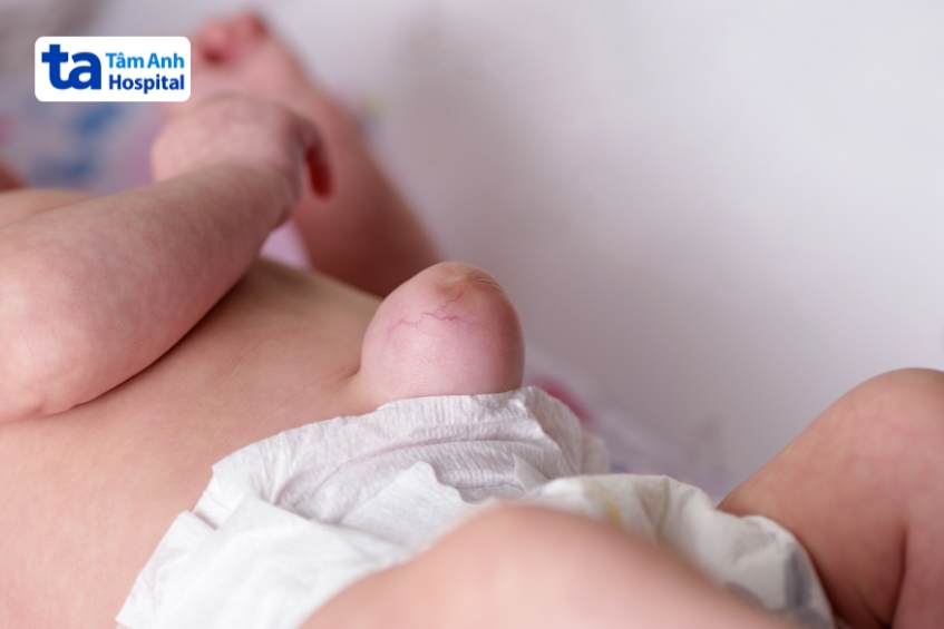 thoát vị rốn ở trẻ sơ sinh