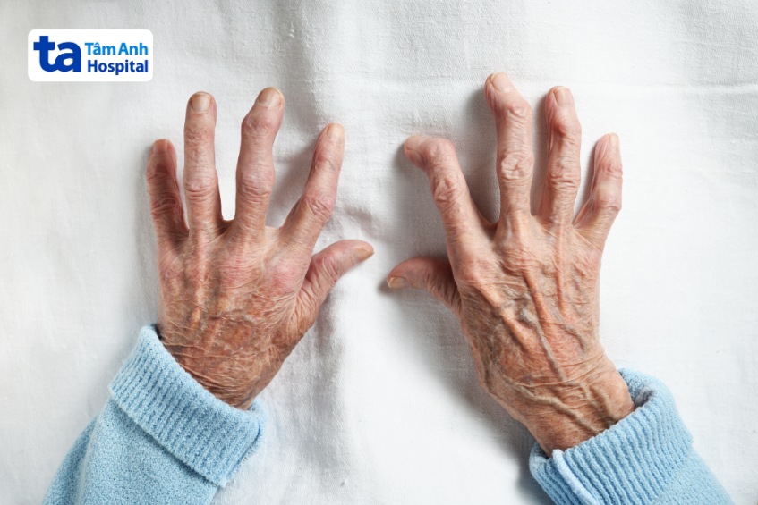 Tình trạng viêm khớp đối xứng ở hai tay