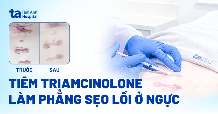 Tiêm triamcinolone làm phẳng sẹo lồi ở ngực