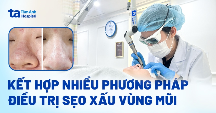 Kết hợp nhiều phương pháp điều trị sẹo xấu vùng mũi